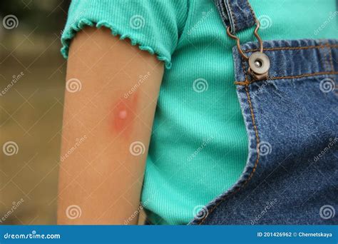 Girl With Insect Bite On Arm Outdoors Closeup Stock Photo Image Of Infection Girl