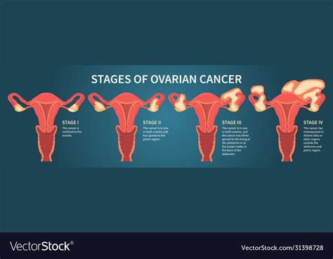 Four Stages Ovarian Cancer Dark Blue Scheme Vector Image