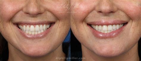How To Reduce Swelling After Lip Fillers Philip Miller Md Facs