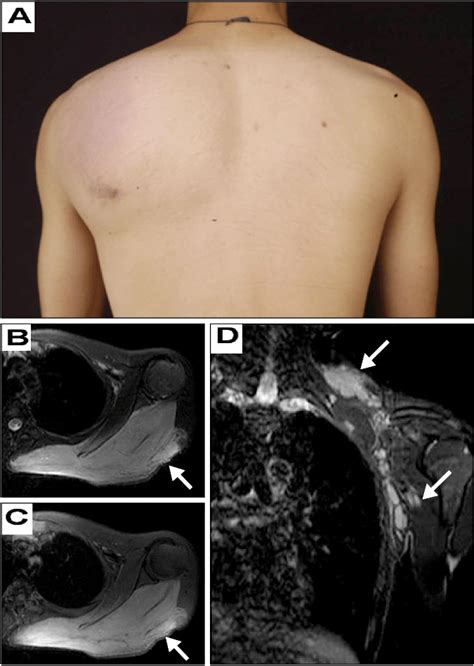A Massive Cutaneous Nodule On The Left Shoulder And Back B Axial