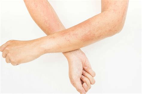 Types Of Skin Rashes In Adults