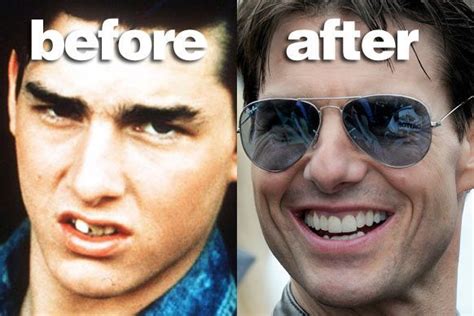 Tom Cruises Dental Transformation The Before And After Pictures Of