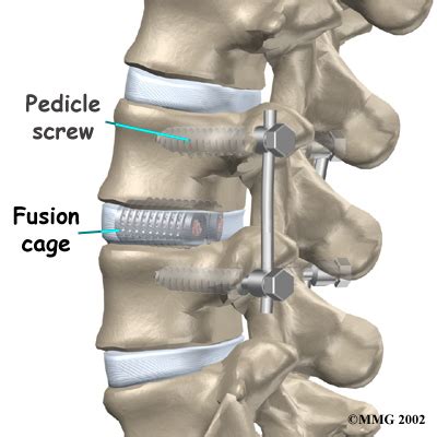 Lumbar Spinal Fusion Spinal Fusion Surgery