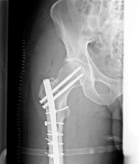 X Ray Of Pinned Fractured Femur Photograph By Dr P Marazziscience