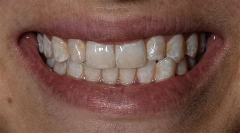 Coeliac Disease Tooth Tongue And Cheek Problems Dr Ken Lipworth