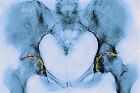 Osteoarthritis Of The Hips X Ray Stock Image C0554994 Science