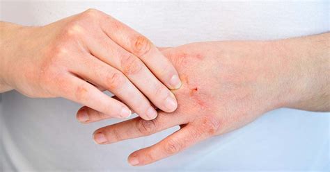 Hand Eczema Everything You Need To Know About Hand Eczema