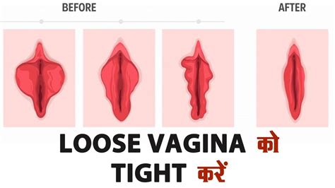 Loose vagina क Tight कर Vagina Tightening YouTube