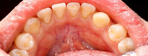 The Two Types Of Harmful Bacteria In The Mouth Implant And Perio Center