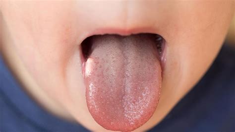 Do Canker Sores Cause Dry Lips
