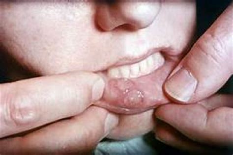 Eliminate Canker Sores In The Mouth Naturally Holistic Living Tips