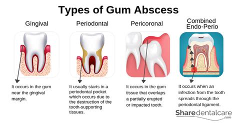 Gum Abscess Symptoms Causes And Treatment Share Dental Care