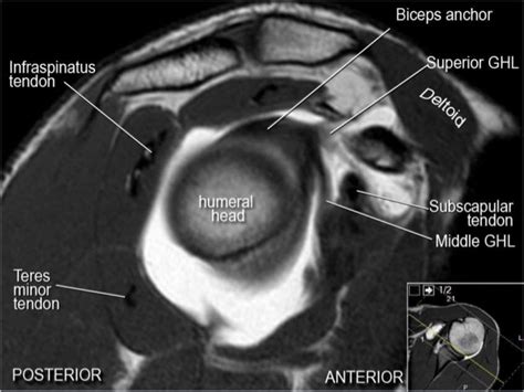 Mri Musculo Skeletal Section Mri Anatomy Of The Shoulder Sagittal View
