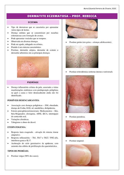 Aula Dermatite Eczematosa Dermatite Eczematosa Prof Rebecca