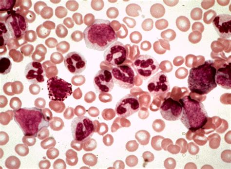 Are Chronic Myeloproliferative Disorders Really Leukemias