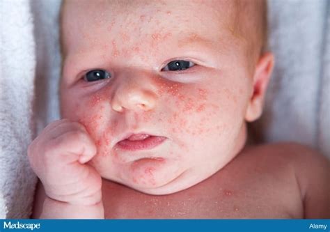 5 Things To Know About Pediatric Acne