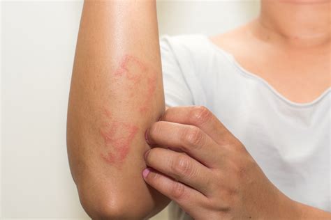 Scaly Skin Potential Causes Symptoms And Treatment Options