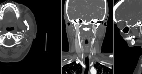 Radiology Mri Partial Double Internal Jugular Vein