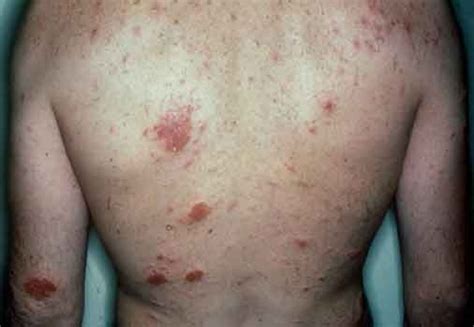 Medical Pictures Info Eczema