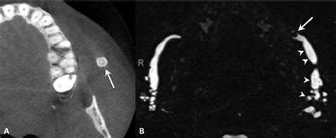 Stensens Duct Sialolithiasis Cone Beam Ct A And Mr Sialography