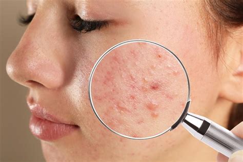 3 Common Types Of Acne And How To Treat Them Rapaport Dermatology Of Beverly Hills Dermatologists