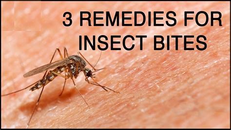 20 best home remedies for mosquito bites to get rid of irritation