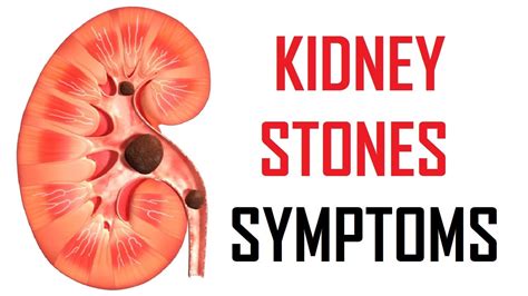 7 Early Signs Of Kidney Stones Kidney Stones Symptoms Youtube