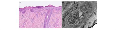 Histopathology Of The Skin Efflorescence In The Sacral Area A