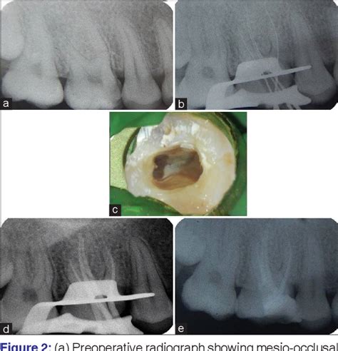 Figure 2 From Endodontic Management Of Maxillary First Molar With