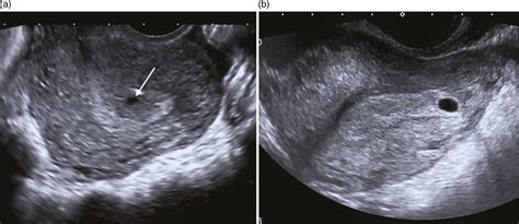 5 Weeks Pregnant Ultrasound Yolk Sac Heterotopic Trig