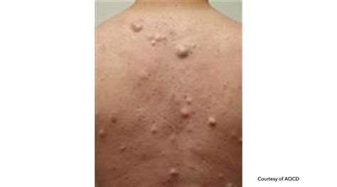 Treatment For Epidermoid Cysts Medical Dermatology Inverness