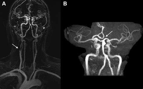 Right Hemiparesis In Right Carotid Stenosis Circulation