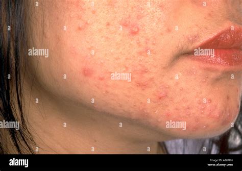 Acne Vulgaris Hi Res Stock Photography And Images Alamy