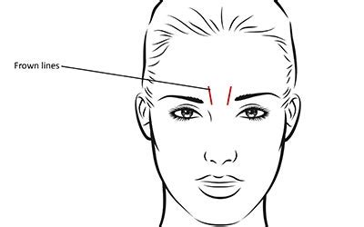 How often to get botox for frown lines. BOTOX®