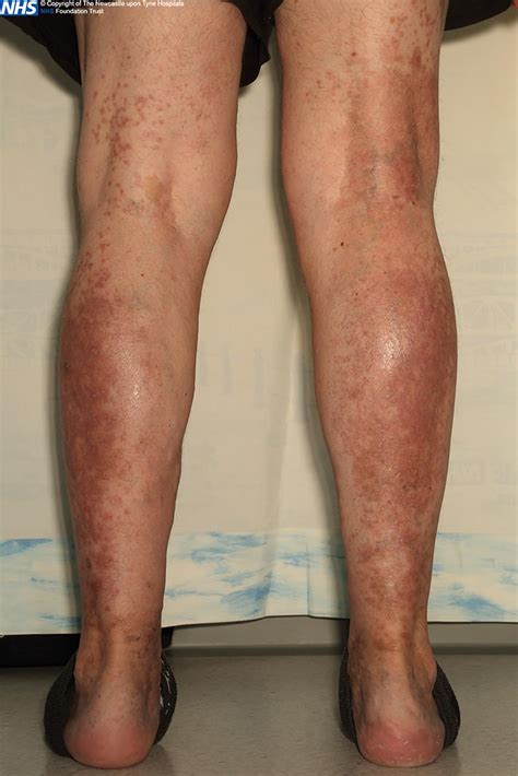 Acute Onset Rash In A Limited Distribution The Bmj