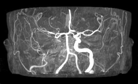 Angio Mri Showing Complete Right Internal Carotid Artery Occlusion In