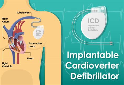 Implantable Cardioverter Defibrillator Icd Placement Cardiovascular