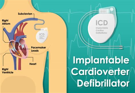 Jun 17, 2021 · eriksen selbst habe dieser behandlung bereits zugestimmt, teilte der dänische verband mit. Implantable Cardioverter Defibrillator (ICD) Placement ...