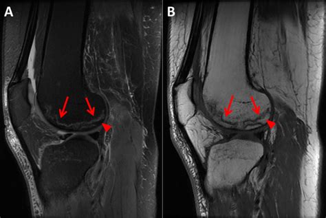 Avascular Osteonecrosis On Distal Femur Evidenced In Right Knee
