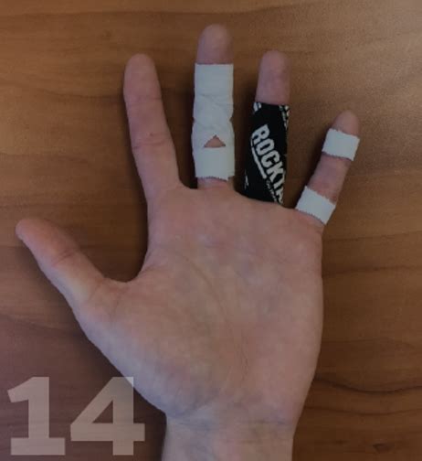 Climbing Finger Injuries What Now