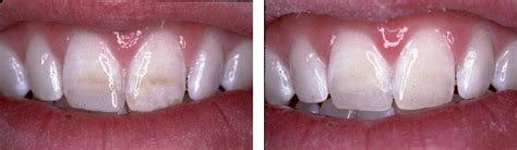 Vertical White Lines On Teeth Teethwalls