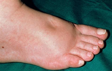What Causes Swollen Feet In Diabetes
