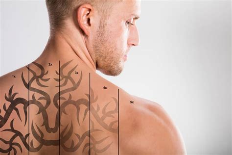 How Much Does Tattoo Removal Cost 2021 Price Guide