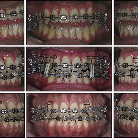 PDF Nonsurgical Correction Of A Severe Anterior Open Bite With