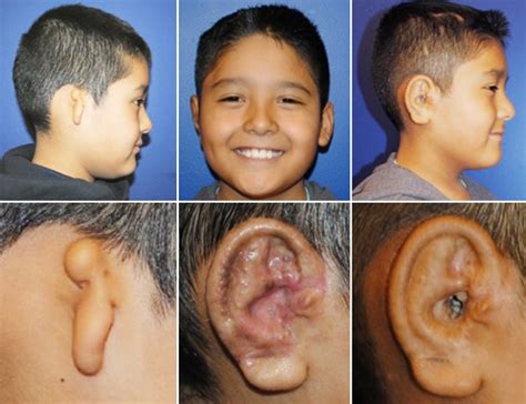 Ear Reconstruction Surgery Childrens Hospital Of Philadelphia