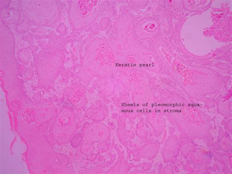Squamous Cell Carcinoma Histopathologyguru