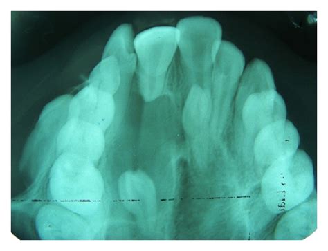 Maxillary Occlusal Radiograph Showing Two Impacted Supernumerary Teeth