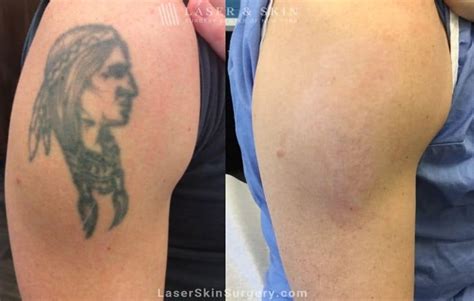 Top More Than 68 Do Tattoo Removals Leave Scars Super Hot Incdgdbentre