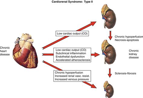 Researchers have been working to understand the clear relationship between kidney disease and heart disease. Cardiorenal Syndrome | SpringerLink