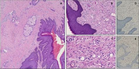 Giant Fibroepithelial Vulvar Polyp In A Pregnant Woman BMJ Case Reports